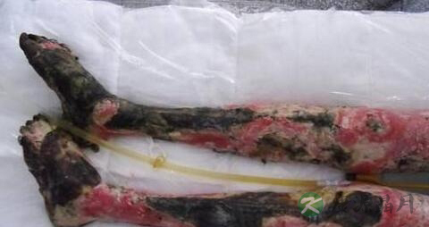 烧伤级别有哪些 烧伤级别有哪些