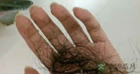 遗传脱发怎么治疗最好 遗传脱发怎么治疗最好
