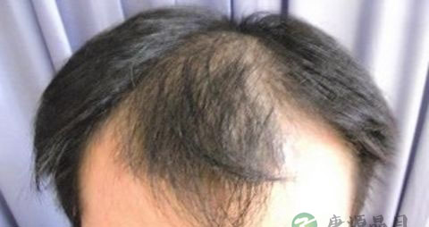 遗传脱发怎么治疗最好 遗传脱发怎么治疗最好