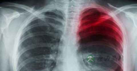 肺癌咳嗽怎么办