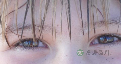 肝脏不好眼角发黑怎么办 肝脏不好眼角发黑怎么办