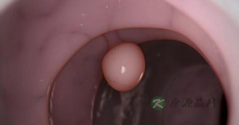 胆囊息肉可以吃大枣吗 胆囊息肉可以吃大枣吗