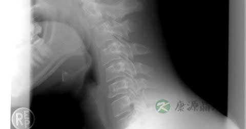 颈椎神经损伤怎么治