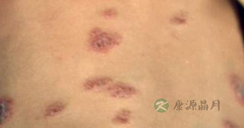 松花粉能治湿疹吗 松花粉能治湿疹吗