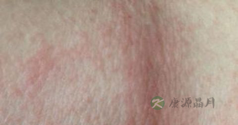 松花粉能治湿疹吗 松花粉能治湿疹吗