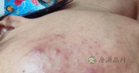 松花粉能治痘痘吗 松花粉能治痘痘吗