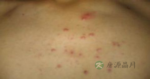 松花粉能治痘痘吗 松花粉能治痘痘吗