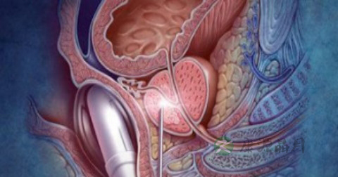 前列腺癌9级是晚期吗 前列腺癌9级是晚期吗