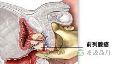 前列腺癌9级是晚期吗 前列腺癌9级是晚期吗