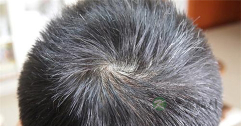 男人哪长白发是肾虚 男人哪长白发是肾虚