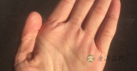 手脱皮怎么治