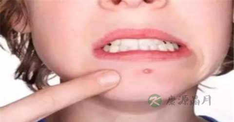 粉刺跟痤疮有什么区别