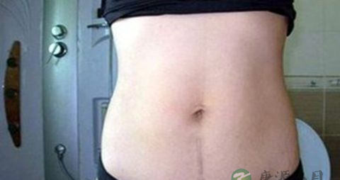 剖腹产后有什么后遗症 剖腹产后有什么后遗症