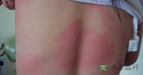 怎么治荨麻疹 怎么治荨麻疹