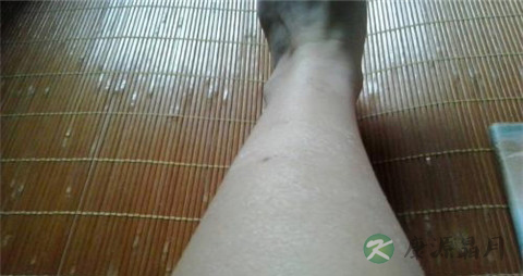 动脉硬化的典型症状 动脉硬化的典型症状