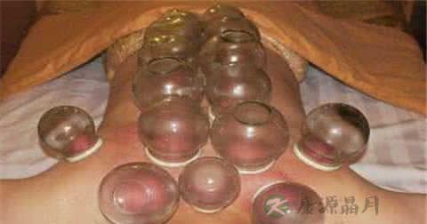 背部拔罐可以减肥吗 背部拔罐可以减肥吗