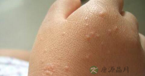 真菌性皮肤病怎么治