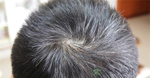 秃发性毛囊炎用什么药 秃发性毛囊炎用什么药