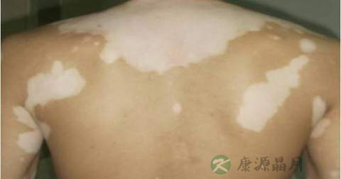 什么是白癜风 什么是白癜风
