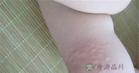 人工性荨麻疹怎么治疗 人工性荨麻疹怎么治疗