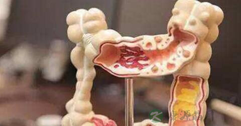 大肠多发息肉怎么办 大肠多发息肉怎么办