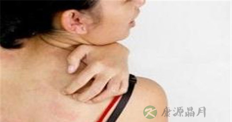 眼睑神经性皮炎特征
