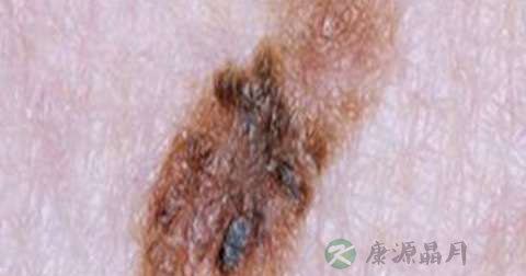 什么是黑色素瘤 什么是黑色素瘤