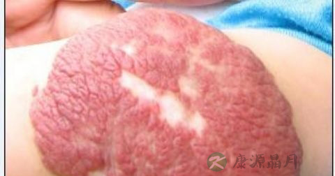 海绵状血管瘤会自己消失吗 海绵状血管瘤会自己消失吗