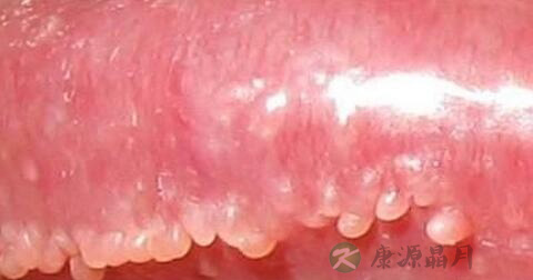 珍珠状丘疹的症状 珍珠状丘疹的症状