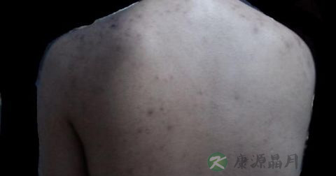 肛门毛囊炎挂什么科 肛门毛囊炎挂什么科