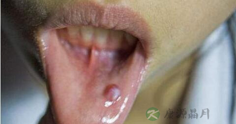 唾液腺囊肿怎么治疗 唾液腺囊肿怎么治疗