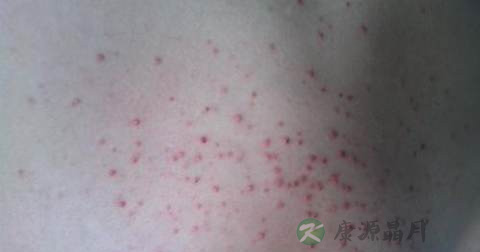 马拉色菌毛囊炎的发病原因 马拉色菌毛囊炎的发病原因