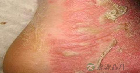 梅毒怎么检查 梅毒怎么检查