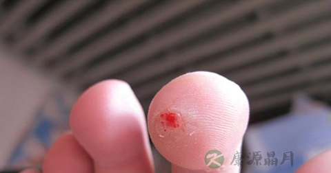瘊子有什么危害 瘊子有什么危害
