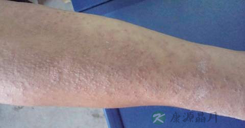 什么是神经性皮炎 什么是神经性皮炎