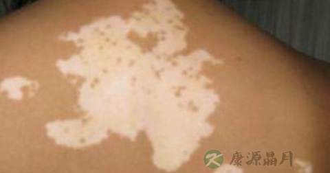 什么是白癜风 什么是白癜风