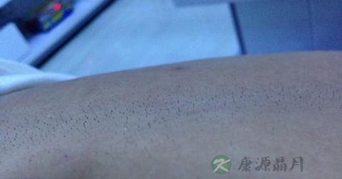 肛门毛囊炎挂什么科 肛门毛囊炎挂什么科