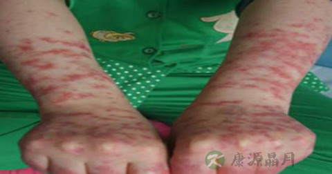 日光性皮炎原因 日光性皮炎原因