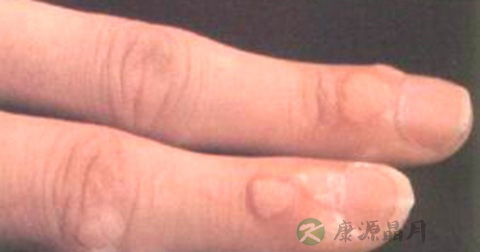 手上为什么会长瘊子 手上为什么会长瘊子