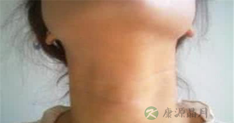 甲状腺囊肿形成的原因