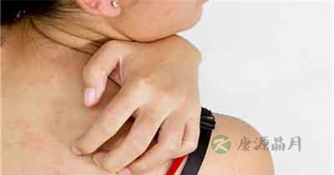 皮炎平能擦脸吗