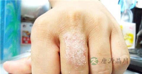 莫匹罗星软膏说明书 莫匹罗星软膏说明书