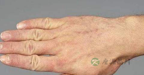 漆疮用什么药擦 漆疮用什么药擦