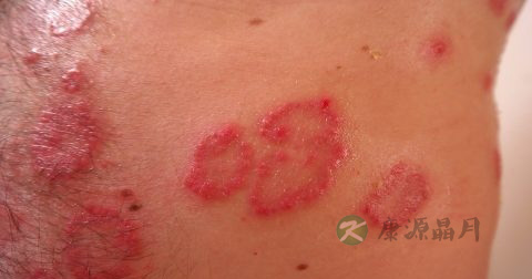 罗红霉素软膏说明书 罗红霉素软膏说明书
