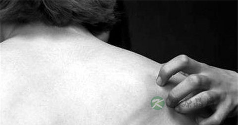 牛皮藓用什么药好 牛皮藓用什么药好
