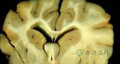 脑白质病吃什么药好 脑白质病吃什么药好