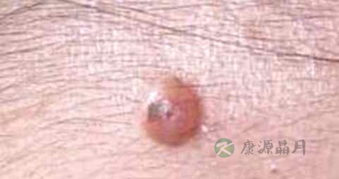 怎样去掉脸上的瘊子 怎样去掉脸上的瘊子