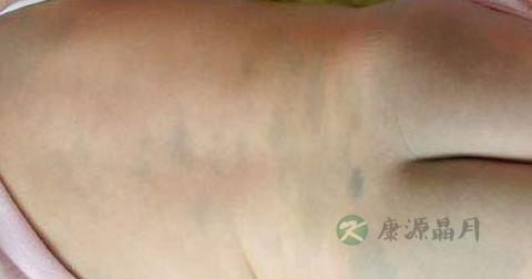 红色胎记怎么治 红色胎记怎么治