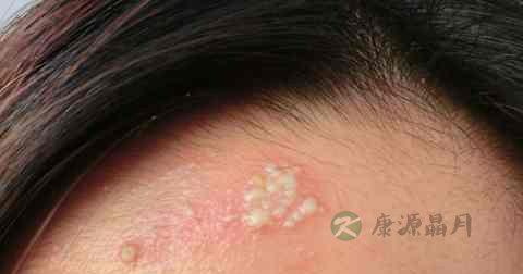 湿毒疮怎么治 湿毒疮怎么治