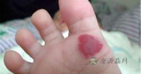 海绵体血管瘤最佳治疗方法 海绵体血管瘤最佳治疗方法